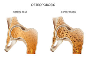 Companion Care at Home Glen Rock NJ - Tips for Living with Osteoporosis